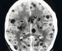 Apdia beeld hersenscan